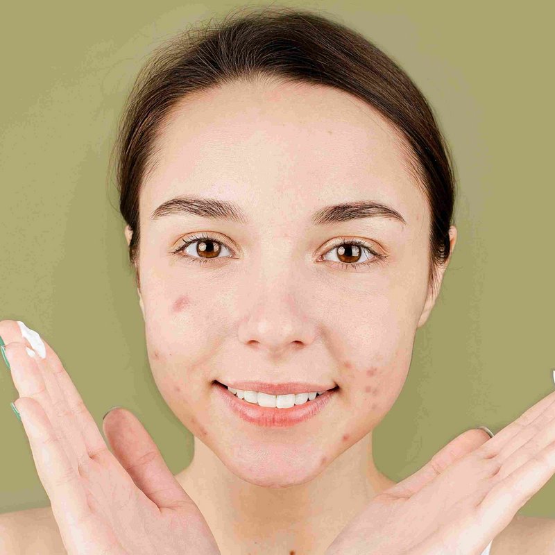 acne-prone-skin-rs-comp